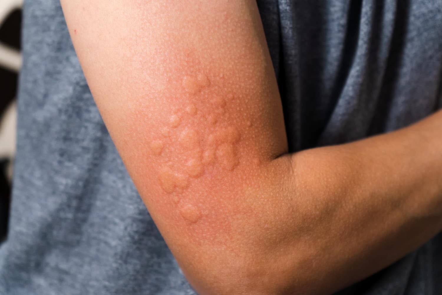 progesterone hypersensitivity